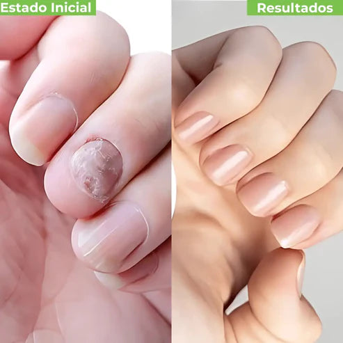 FUNGAL NAIL PATCHES - PARCHES ANTIHONGOS DE RENOVACIÓN PROFUNDA